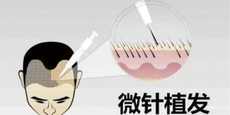 猜一猜:植发所用的毛发通常是自己的还是别人的?-2023支付宝蚂蚁庄园7月19日每日一题答案(2)